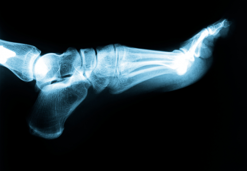  When individuals begin to experience intense pain in their heel, many know that they have acquired plantar fasciitis. This ailment occurs when the plantar fascia ligament along the bottom of the foot develops tears in the tissue. This will result in pain and inflammation of the area closest to the heel bone.   The most common symptoms of plantar fasciitis include:  Burning Stabbing An aching pain in the heel of the foot  The fascia ligament tightens up over night and therefore causes the most pain in the morning. Pain generally decreases as the tissue warms up, but oftentimes returns after long periods of standing or weight bearing and physical activity.   One of the prevalent factors that contribute to plantar fasciitis is wearing incorrect shoes. This includes shoes that either don’t fit properly, or provide inadequate support or cushioning. Weight distribution becomes impaired while wearing shoes that are unsupportive. Therein, adding significantly stress to the plantar fascia ligament.   In most cases, treatment of plantar fasciitis doesn’t require surgery or invasive procedures to stop pain and reverse damage. Traditional treatments are usually all that is required. However, keep in mind that every person's body responds to the treatment differently and recovery times will vary.  Bellevue Podiatrist | Bellevue Plantar Fasciitis | WA | Podiatry |